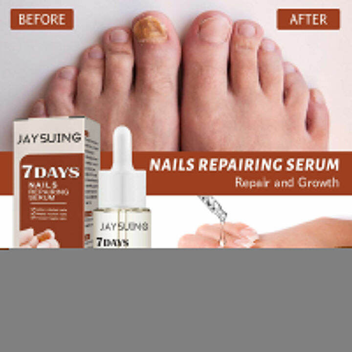 Ingrown Toenail Drops Soften Nail Fungal Treatment Feet Care Essence