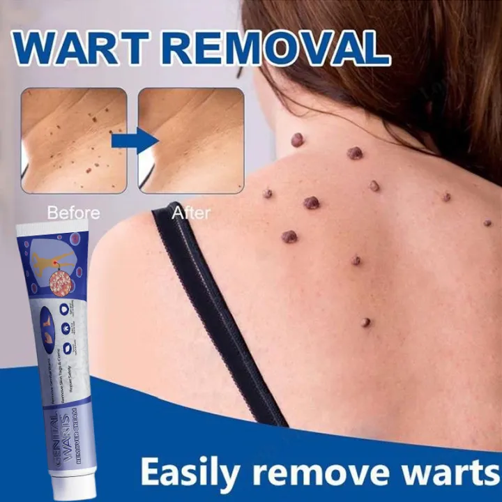 Wart Removal Original Cream Painless Removal Wart Skin Tags Remover