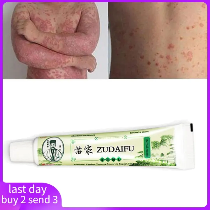 Skin Psoriasis Cream Dermatitis Eczematoid Eczema Ointment Lazada