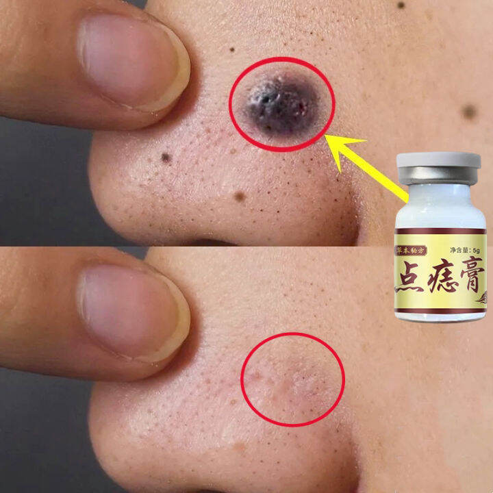 Skin Tag Remover Mole Removal Ubat Kutil Tahi Lalat Ketuat Dan Biji