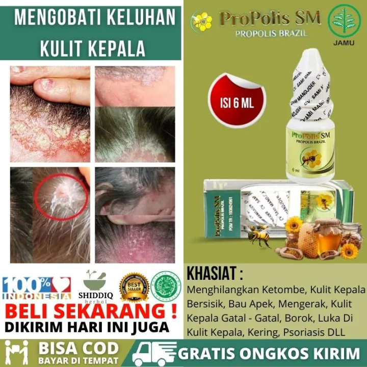 Obat Untuk Jamur Di Kulit Kepala Seperti Ketombe Penghilang Mengerak