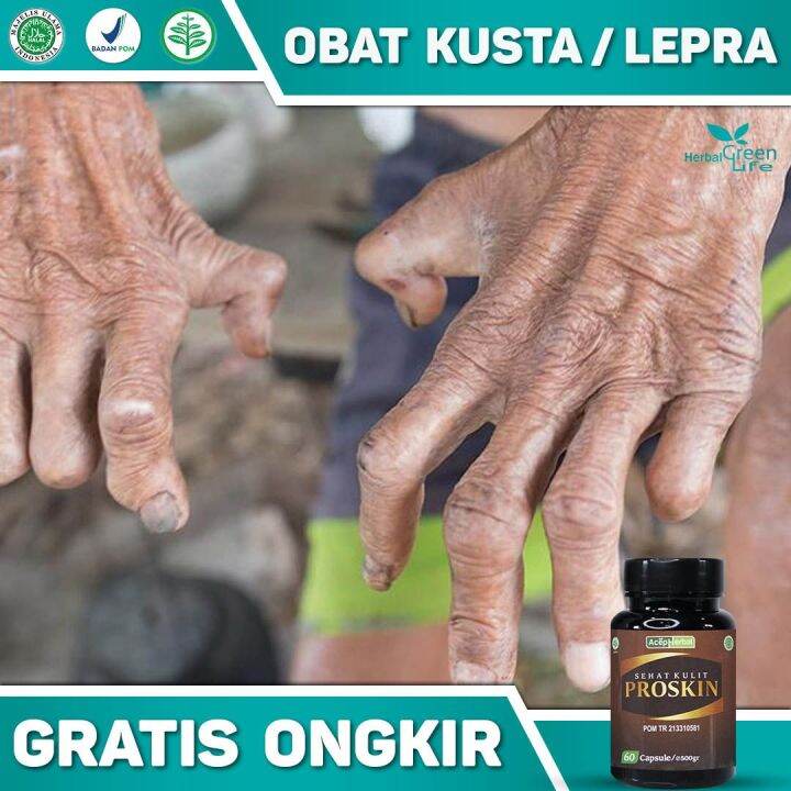 Obat Kusta Lepra Kering Dan Basah Hansen Infeksi Bakteri Kronis