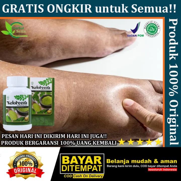 Obat Herbal Untuk Pengempis Kaki Bengkak Alami Edema Perifer Kaki