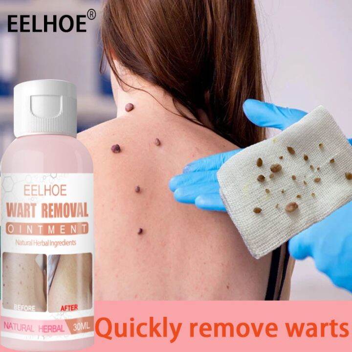 EELHOE Warts Remover Original Cream30mlRemover Flat Moles Warts Remover