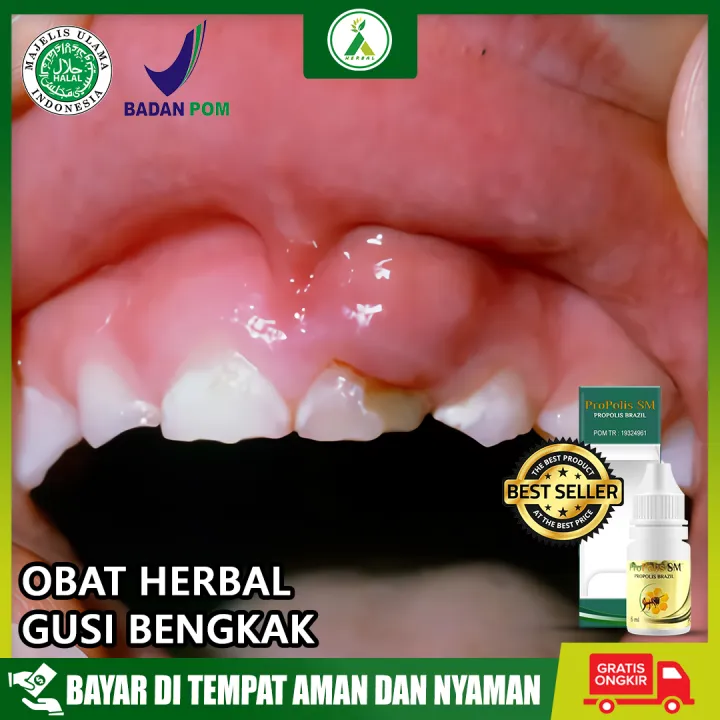 Obat Gusi Bengkak Dan Bernanah Obat Gusi Bengkak Berdarah Propolis