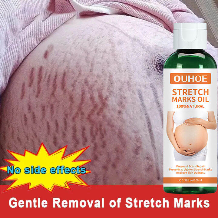 Lighten Pigmentation Maternity Skin Repair Treatment Scars Repair