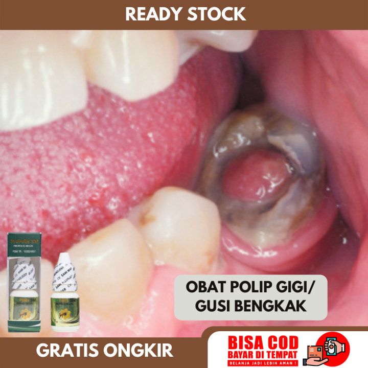 Obat Polip Gigi Obat Tumbuh Daging Jadi Di Gigi Obat Polip Pulpa