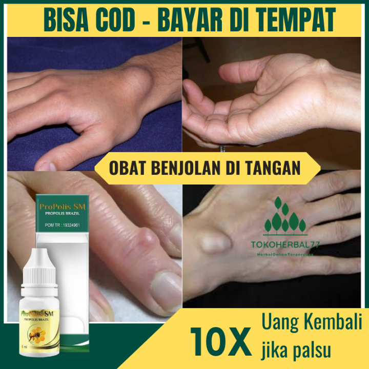 Obat Benjolan Di Tangan Penghilang Benjolan Ganglion Penghancur