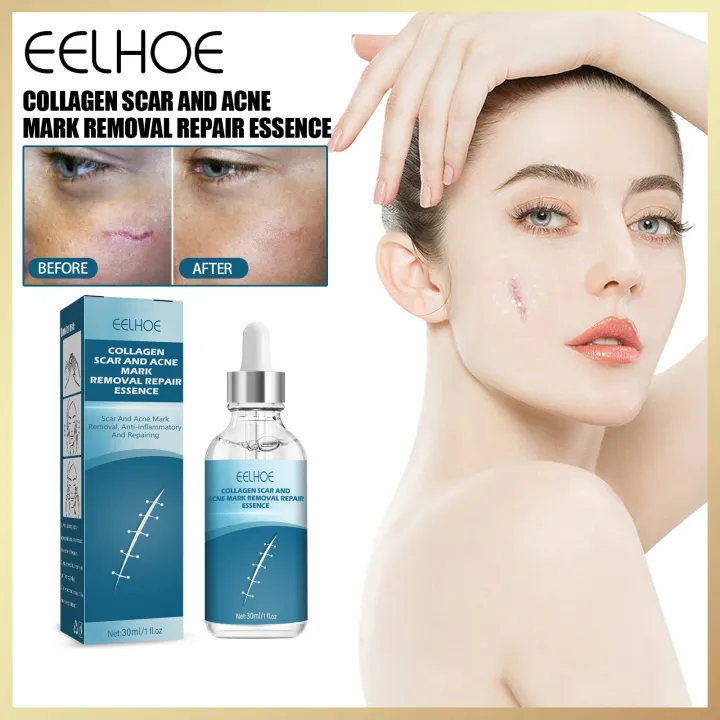 Eelhoe Collagen Scar And Ance Mark Removal Repair Essence Acne Scar