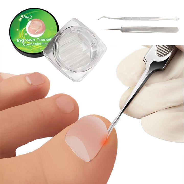 10pcs Ingrown Toenail Correction Tool Ingrown Toe Nail Treatment