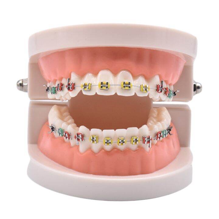 Dental Orthodontic Treatment Model With Ortho Metal Ceramic Bracket