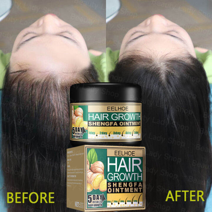 Just 5 Days Ginger Hair Growth Treatment Hair Growth Ointment Hair