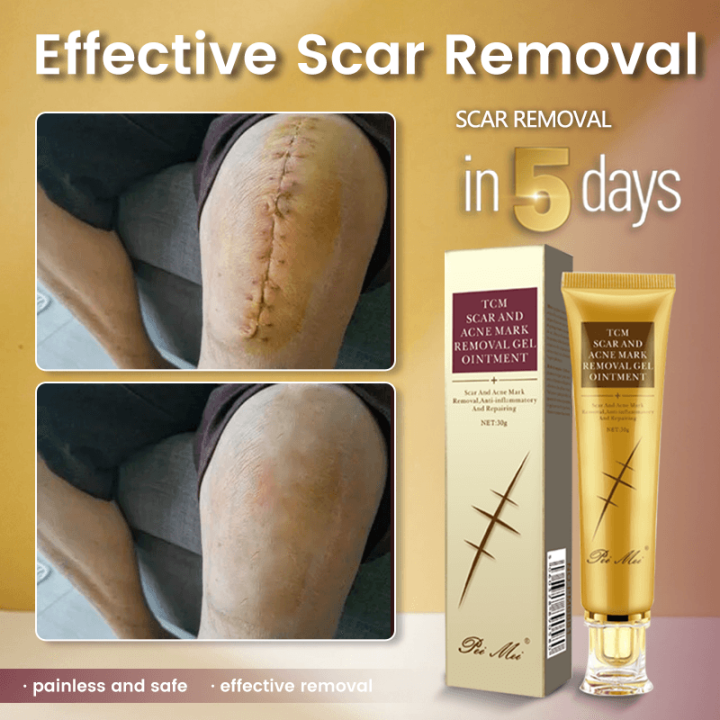 Scar Remover Scars Remover For Old Scars Stretch Mark Remover Scars