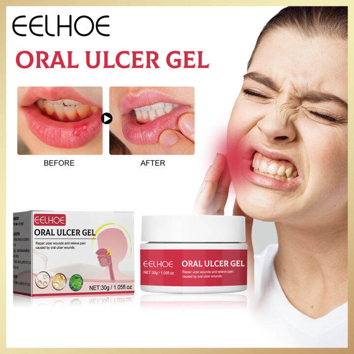 Eelhoe Oral Ulcer Gel Natural Herbal Relief Mouth And Tongue Severe