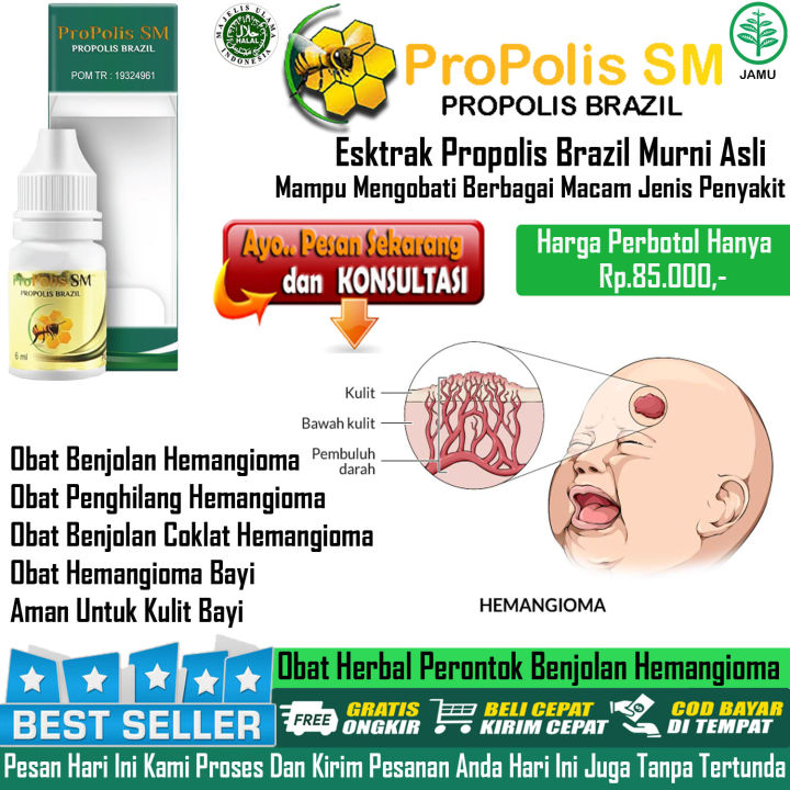 Obat Hemangioma Penghilang Tanda Lahir Merah Bayi Perontok Hemangioma