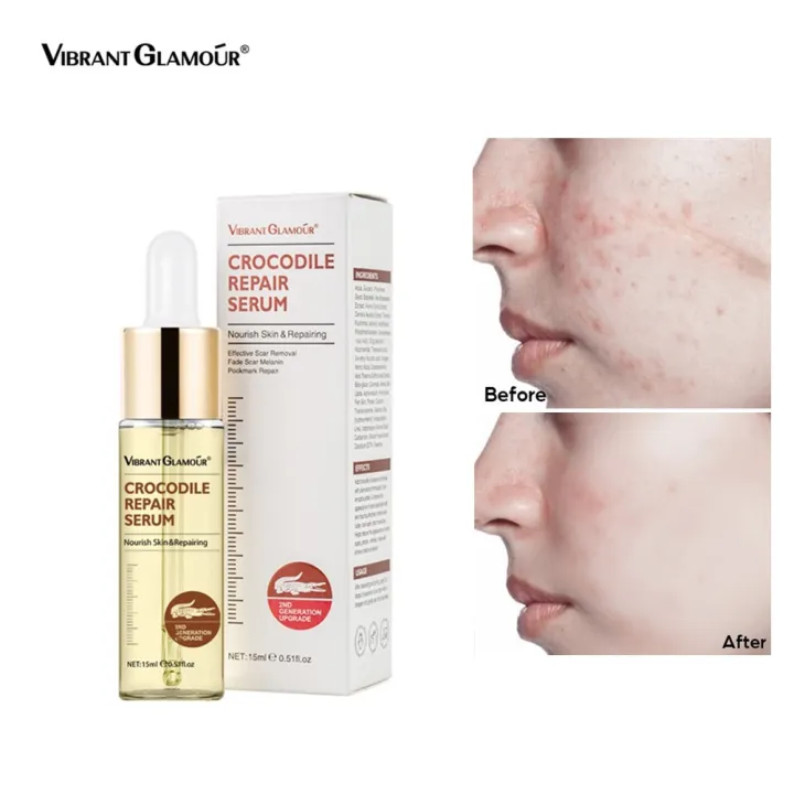 Vibrant Glamour Ml Freckle Removal Serum Effective Scar Removal