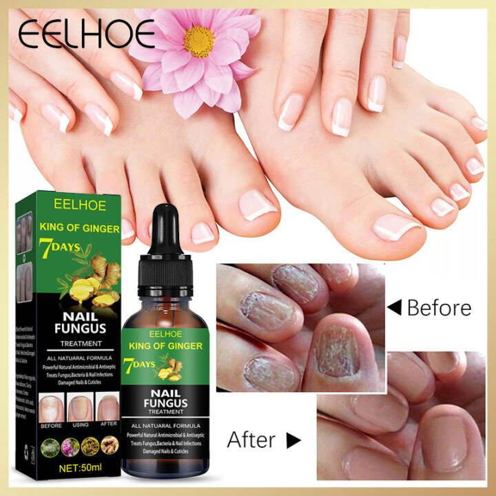 Eelhoe Days Nail Fungus Treatment Repair Liquid Ginger Foot Anti