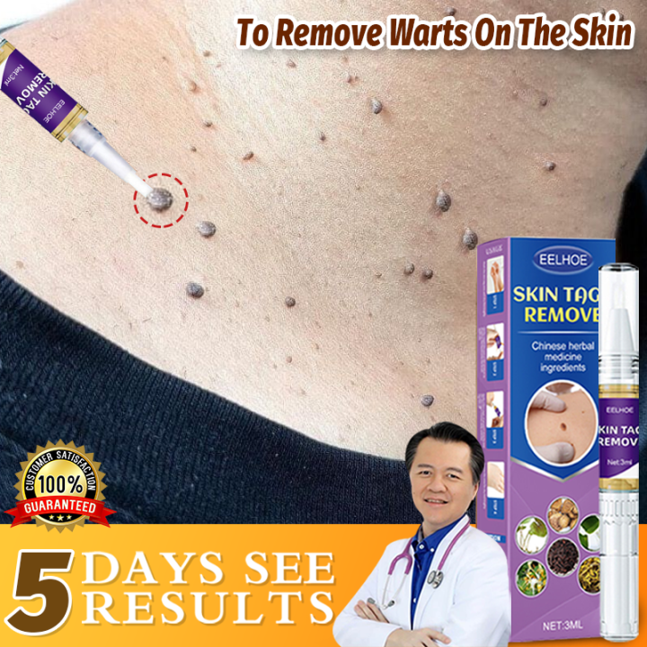 Warts Remover Original Watson Mole And Warts Remover Warts Removal Skin