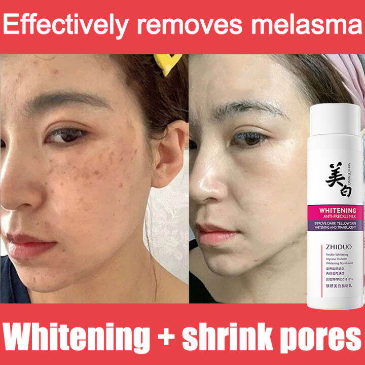 Days Effectiveeffective Whitening Freckle Cream Original