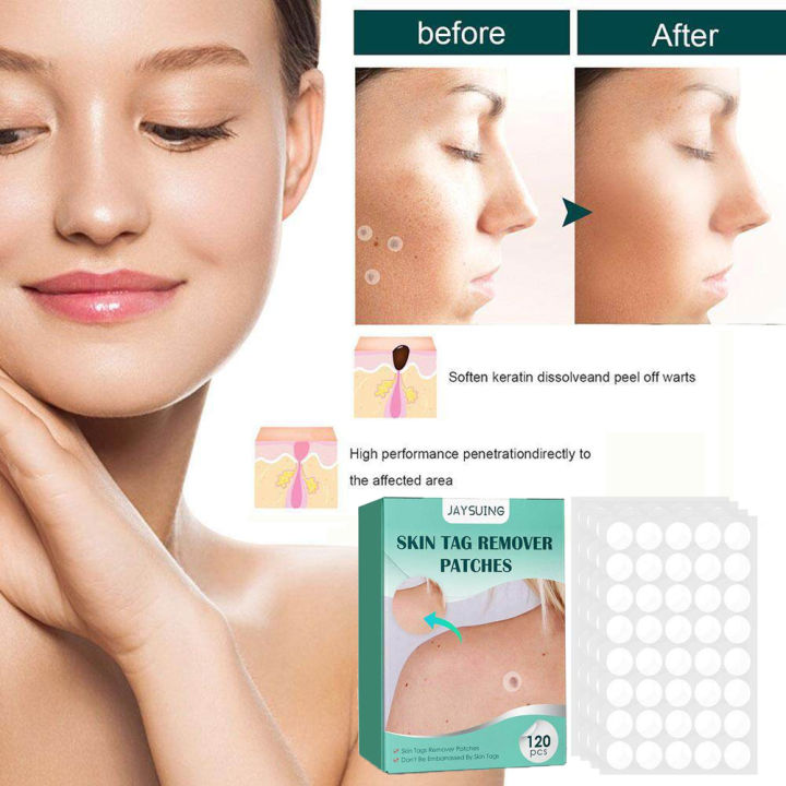 JAYSUING Acne Pimple Patches Warts Removal Sticker Pimples Removal