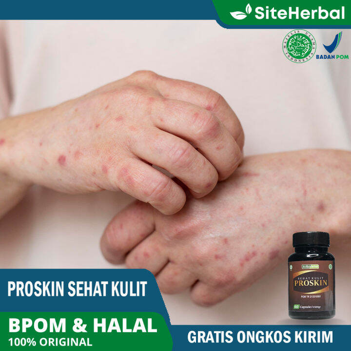 Obat Kusta Kusta Kering Basah Bakteri Kulit Melepuh Ruam Kemerahan