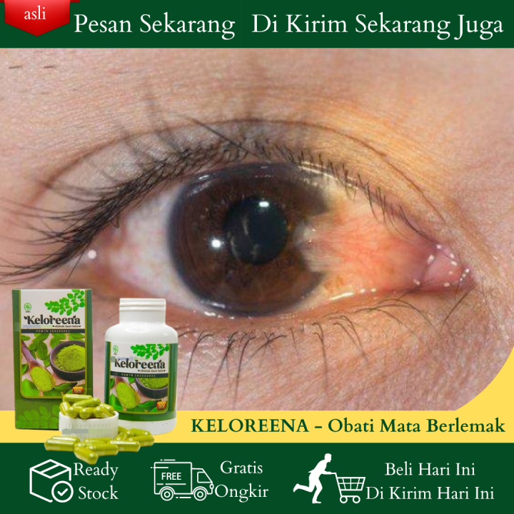 Obat Mata Berlemak Parah Mata Pterygium Pterigium Herbal Mata