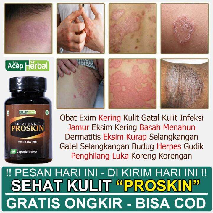 Obat Exim Kering Kulit Gatal Kulit Infeksi Jamur Eksim Kering Basah