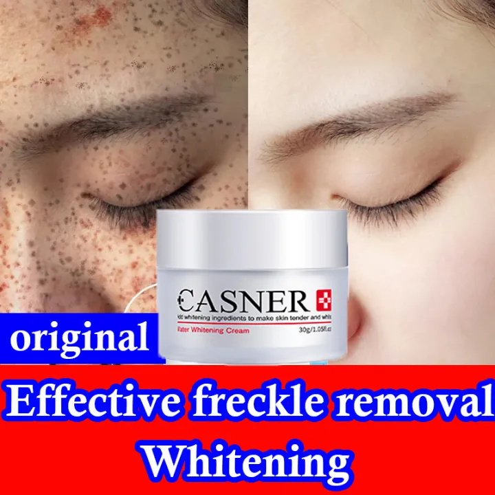 Whitening Freckle Removal Cream Fast Effective Freckle Removal