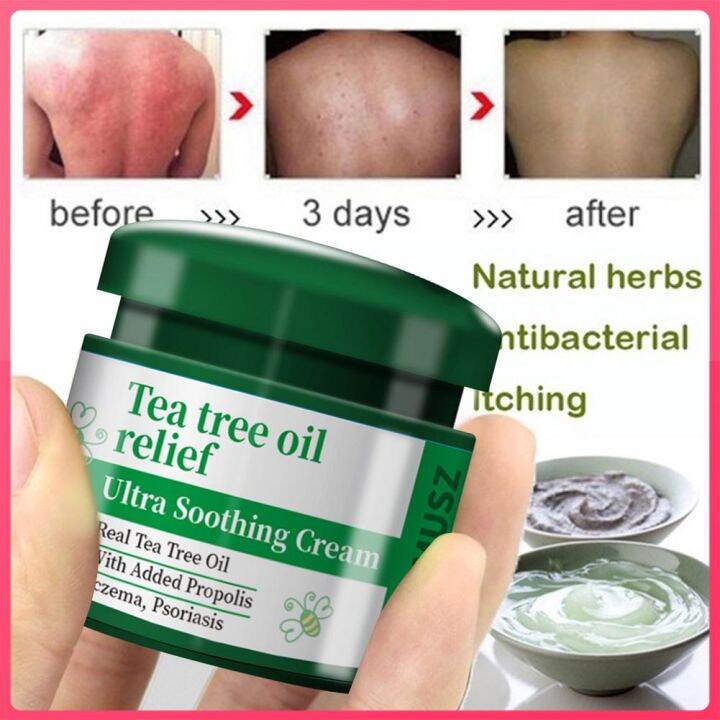 Fast Deliverypsoriasis Ointment Psoriasis Treatment Cream Eczema