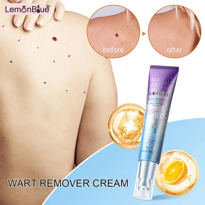 Wart Remover Cream 20g Lazada