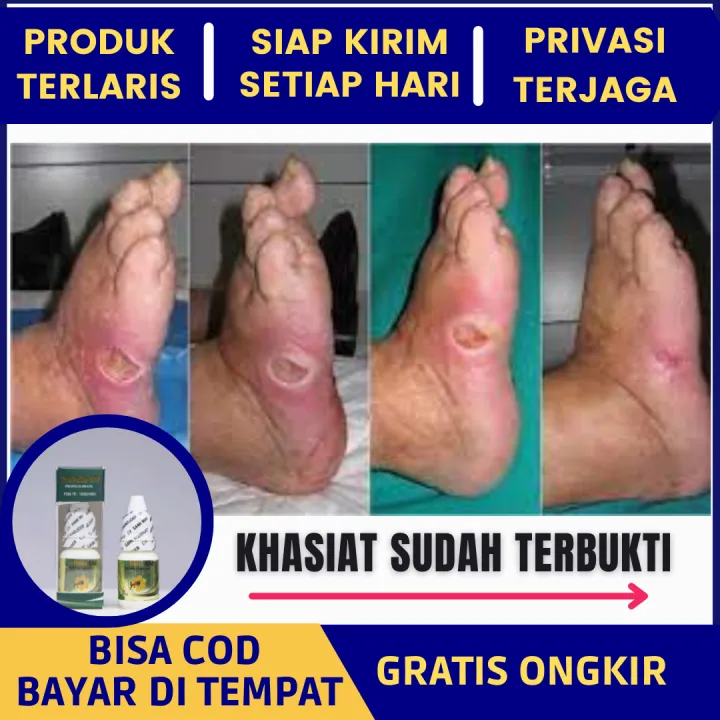 Propolis SM Untuk Obat Luka Diabetes Melitus Basah Kering Bernanah