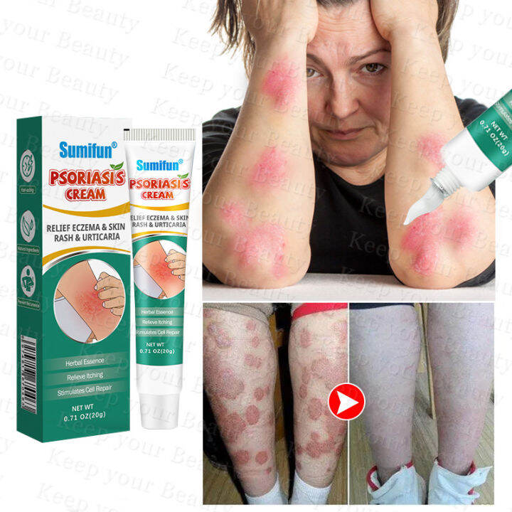 Sumifun Herbal Psoriasis Cream G Herbal Antibacterial Cream Ointment