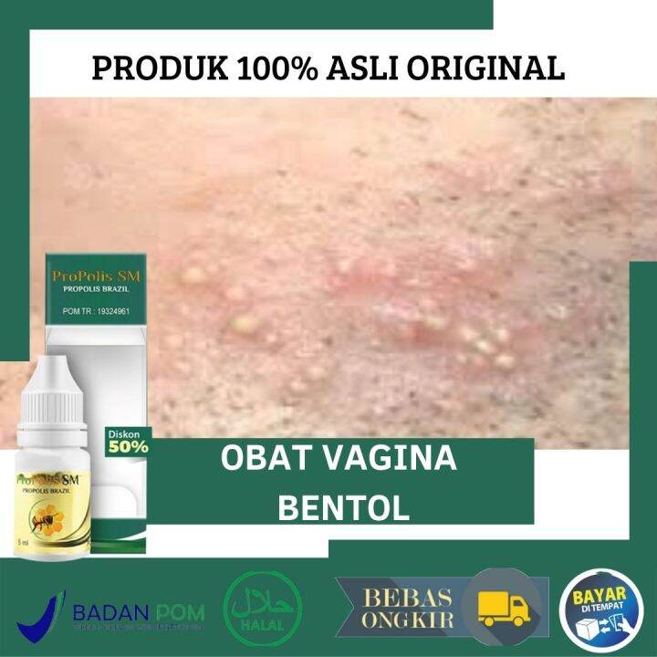 Obat Bentol Vagina Herbal Benjolan Gatal Pada Vagina Ruam Gatal