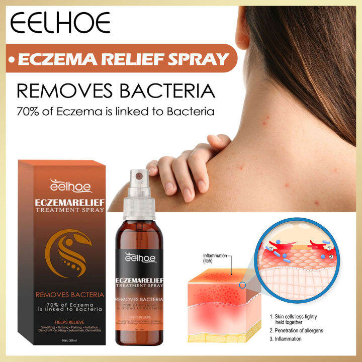 Eelhoe Eczema Relief Treatment Spray Psoriasis Treatment Spray Hand