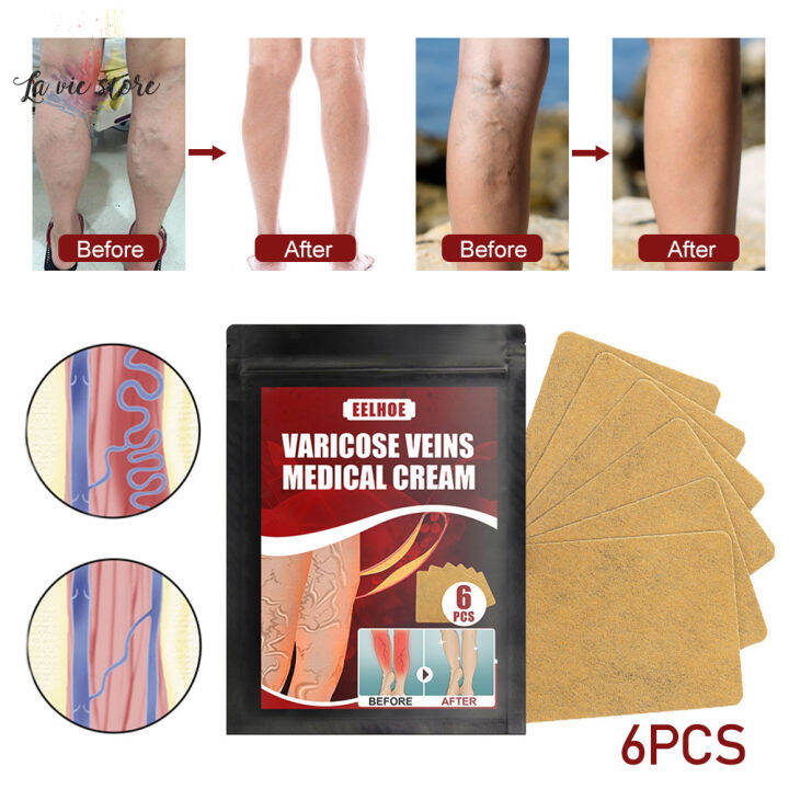 La Vis Varicose Veins Patch For Phlebitis Angiitis Inflammation