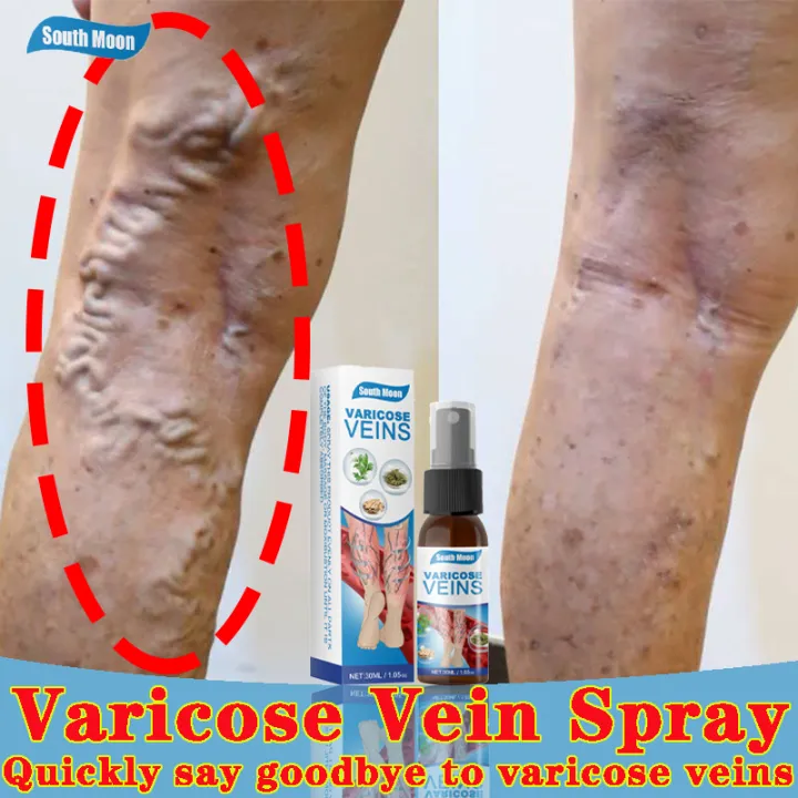 Varicose Veins Treatment Original Genuine Effective Spider Veins