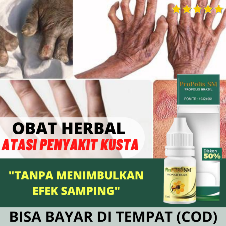 Obat Penyakit Kusta Kering Basah Penyakit Lepra Infeksi Kronis Lesi