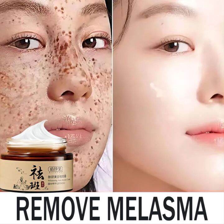 Ultimate Pekas Cream Days Goodbye Sumpa Kana For Freckles Melasma