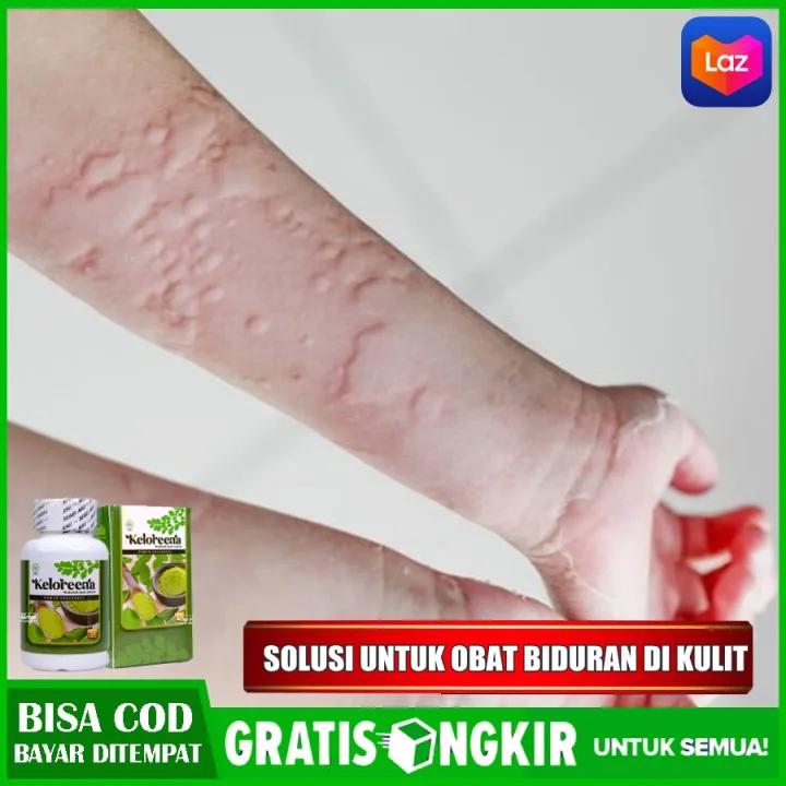 Obat Untuk Biduran Herbal Untuk Mengobati Gatal Gatal Di Kulit Obat