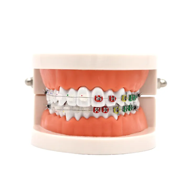 Dental Orthodontic Treatment Model With Ortho Metal Ceramic Bracket