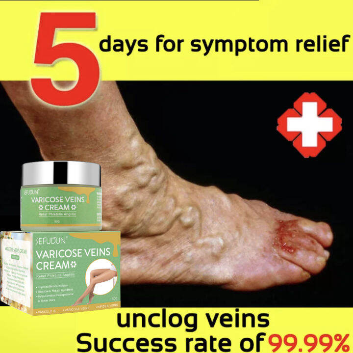 Original Sefudun Varicose Vein Treatment Cream Spider Vein Pain