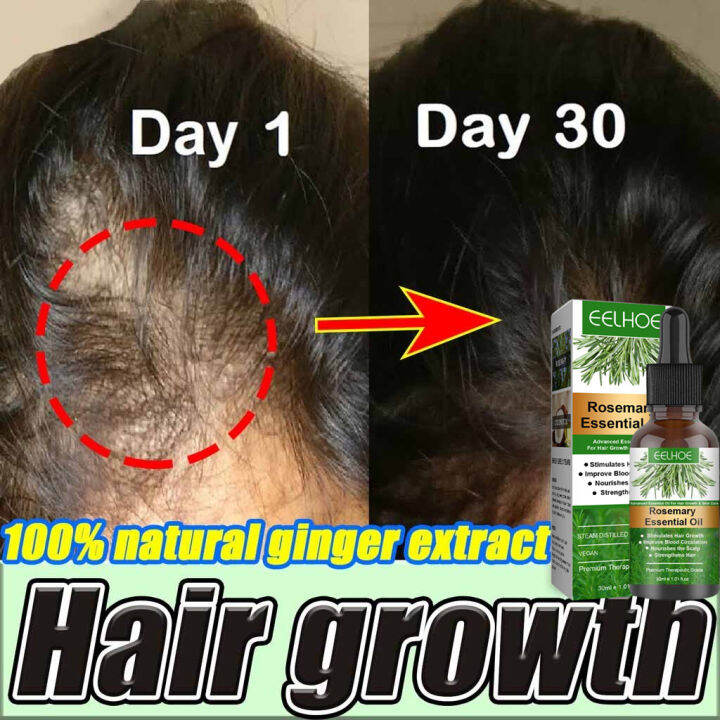 Eelhoe Rosemary Hair Growth Essential Oil Anti Hair Loss Fast Regrowth