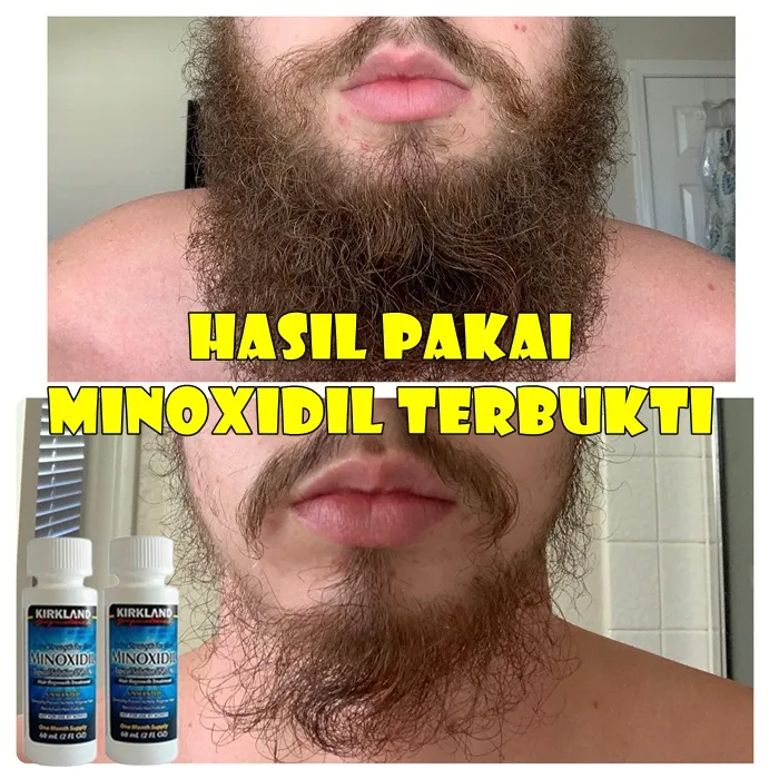 Redy Minoxidil Original Asli Penumbuh Rambut Minoxidil Original