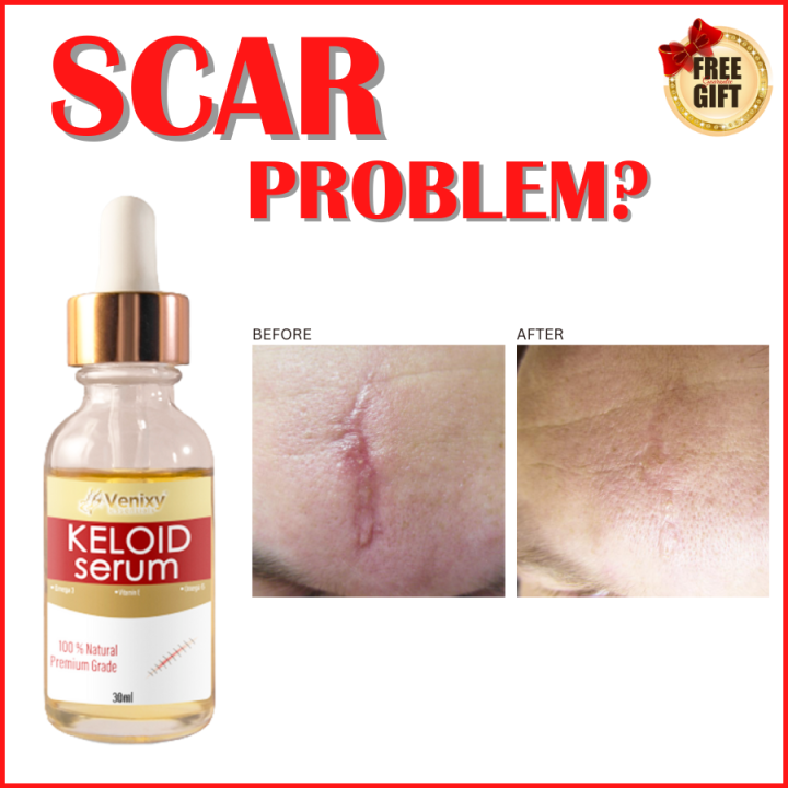 Scar Remover Keloid Serum Scar Remover Scar Remover Peklat Remover