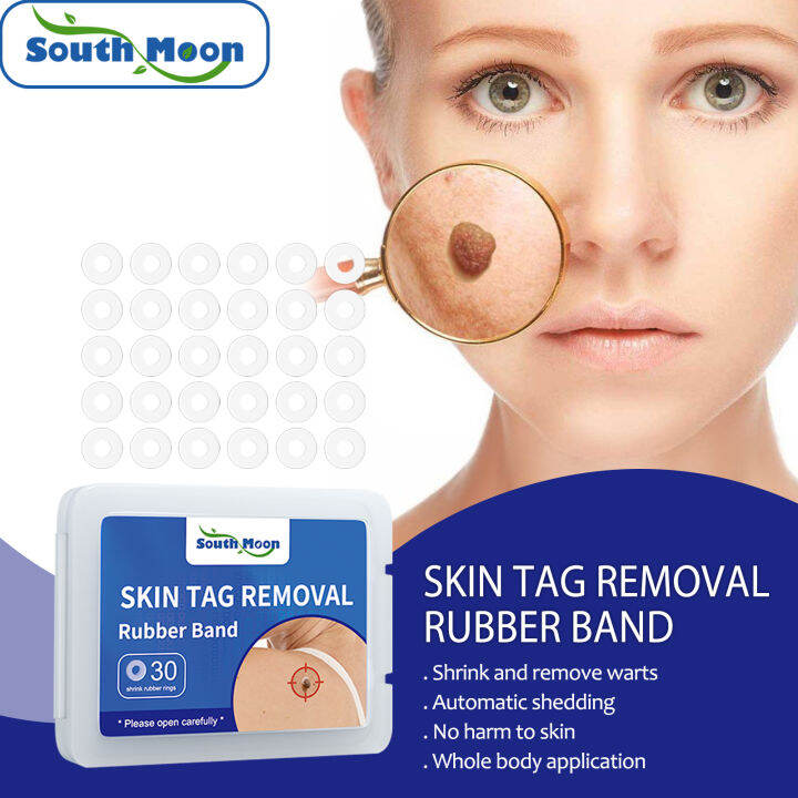 South Moon Skin Tag Removal Rubber Band Skin Warts Removal No Bleeding