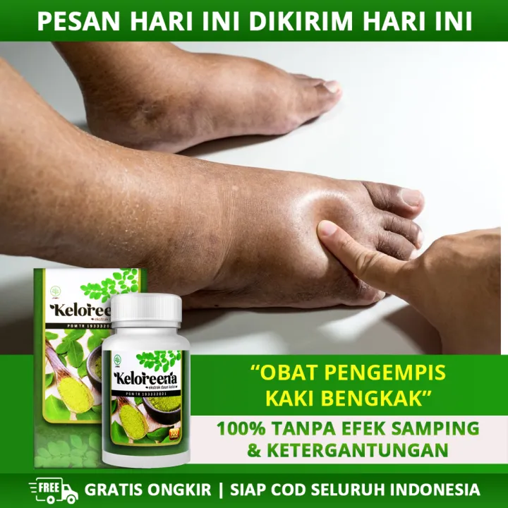 Obat Herbal Penghilang Pengempis Kaki Bengkak Asam Urat Keseleo