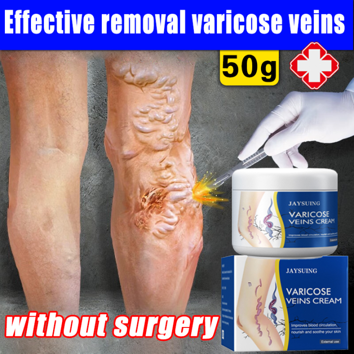 Genuine Guaranteejaysuing Varicose Vein Original Cream G Spider