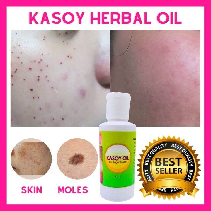 The Trends Shoppe Original Kasoy Herbal Oil Kasoy Oil Warts Remover