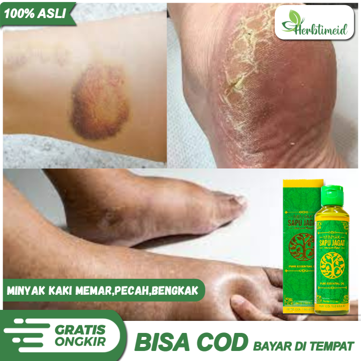 Minyak Oles Herbal Kaki Bengkak Dan Keram Kaki Keseleo Kaki Lemas Kaki