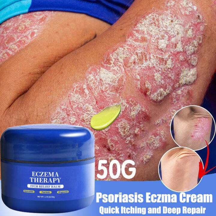 Nekvnro Specialized Treatment Psoriasis Treatment Cream Antifungal